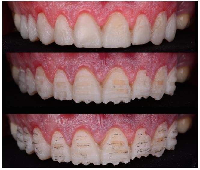 Altered Passive Eruption: A Combined Perio-Restorative Approach: A Case Report